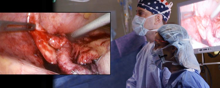 Laparoscopic-Appendectomy-and-Open-Umbilical-Hernia-Repair