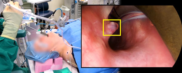 Direct-Microlaryngoscopy-and-Excision-of-Vocal-Cord-Lesion