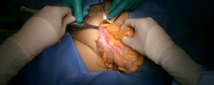 Left-Indirect-Inguinal-Hernioplasty