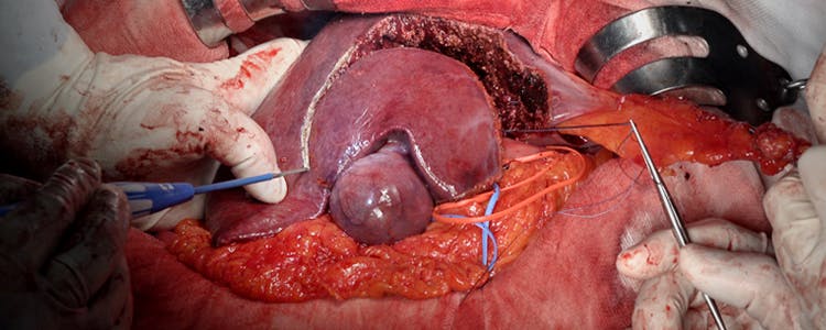 Open-Radical-Cholecystectomy-with-Partial-Hepatectomy-for-Gallbladder-Cancer