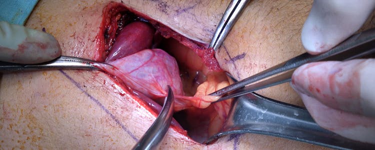 Open-Cholecystectomy-for-Gallbladder-Disease