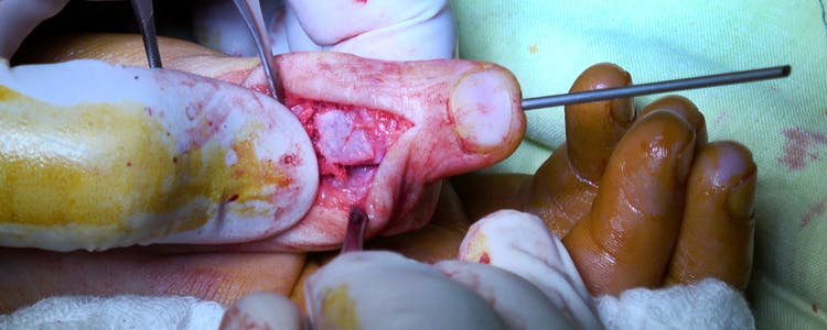 bone-graft-for-nonunion-of-right-thumb-proximal-phalanx-fracture