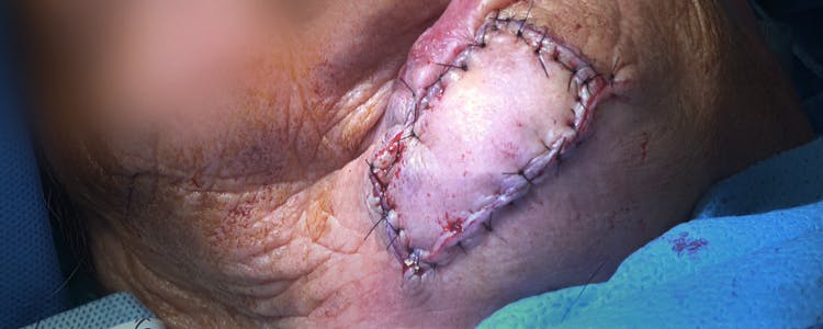 Basal-Cell-Carcinoma-Excision-from-Lower-Lip-with-Keystone-Flap-Reconstruction