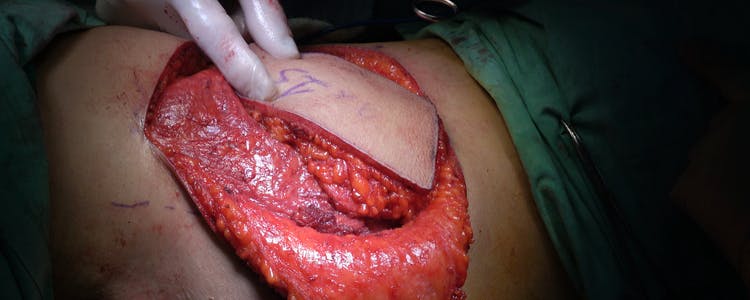 left-mastectomy-wound-closure-with-left-latissimus-dorsi-musculocutaneous-local-flap