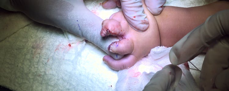 Bilateral-Syndactyly-Release-of-Third-and-Fourth-Fingers