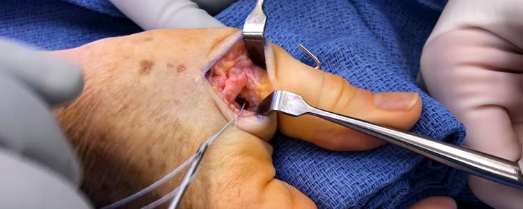 Thumb-Ulnar-Collateral-Ligament-Tear-Repair