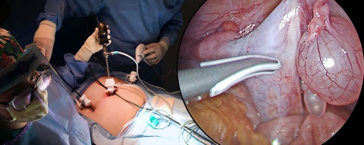 prophylactic-laparoscopic-bilateral-gonadectomy-for-complete-androgen-insensitivity-syndrome