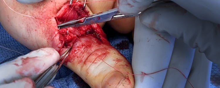 thumb-extensor-tendon-laceration-repair