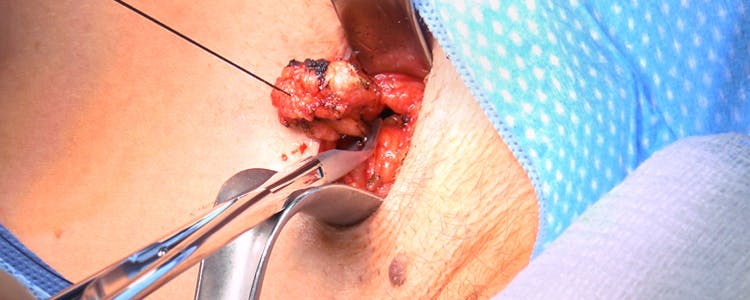 wide-local-excision-of-an-intermediate-thickness-back-melanoma-with-a-sentinel-lymph-node-biopsy-of-left-axillary-lymph-nodes