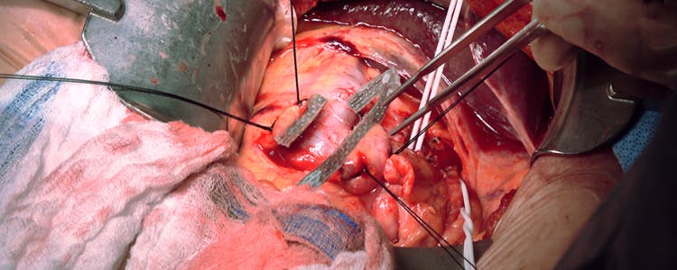 open-distal-pancreatectomy-for-pancreatic-cancer
