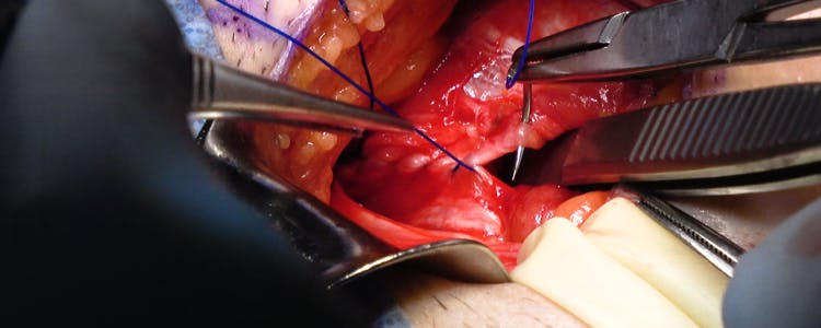 shouldice-repair-for-left-direct-inguinal-hernia