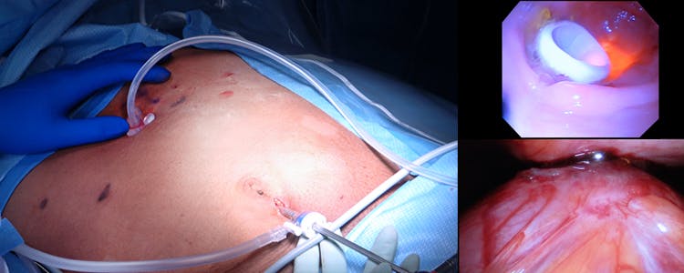 laparoscopic-assisted-percutaneous-endoscopic-gastrostomy-(peg)-tube-placement