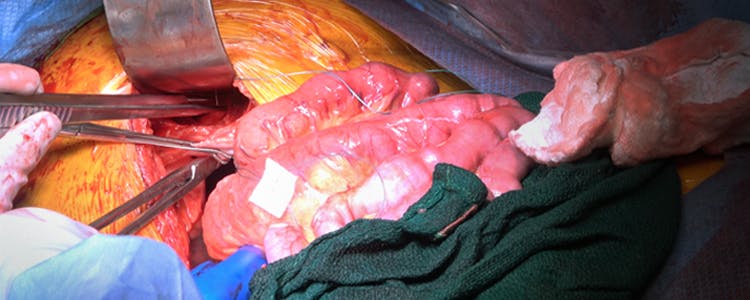 exploratory-laparotomy-for-bowel-obstruction-with-primary-repair-of-two-diaphragmatic-hernias