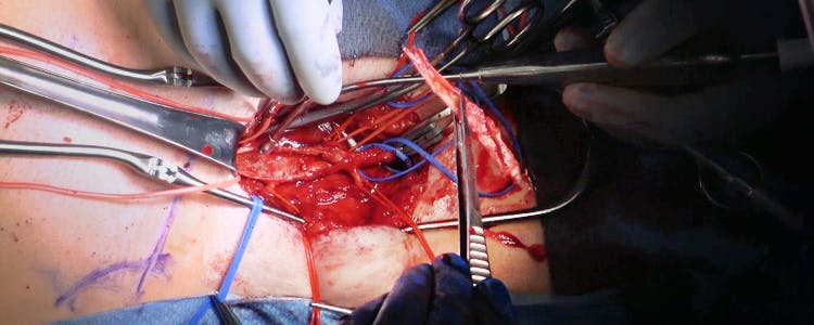 femoral-endarterectomy-for-severe-peripheral-arterial-disease