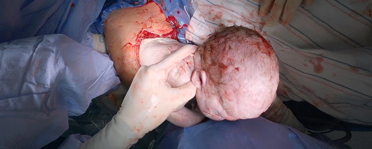 primary-low-transverse-c-section