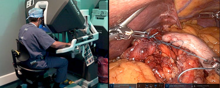 robotic-assisted-laparoscopic-paraesophageal-hiatal-hernia-repair-with-fundoplication-and-esophagogastroduodenoscopy