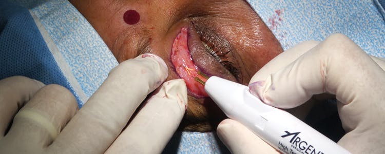 blepharoplasty-for-bilateral-upper-eyelids