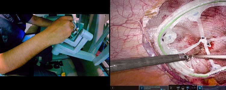 robotic-assisted-laparoscopic-(rtapp)-umbilical-hernia-repair-with-intra-abdominal-preperitoneal-underlay-mesh-(ipum)