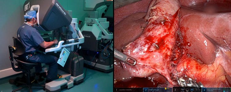 robotic-assisted-laparoscopic-interval-cholecystectomy