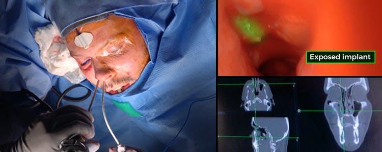 neuronavigation-and-endoscopy-as-adjunctive-tools-in-orbital-floor-implant-revision:-surgical-management-of-infected-misplaced-orbital-floor-implant-with-chronic-eyelid-fistula-and-sinusitis