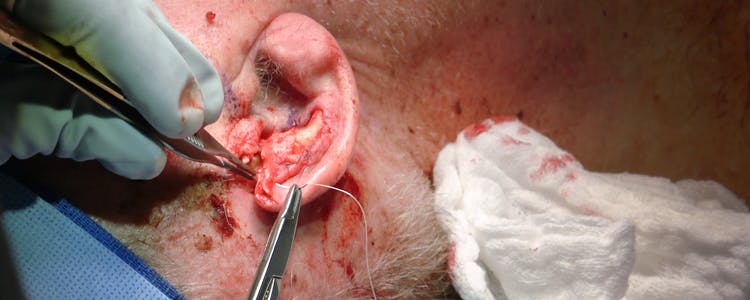 local-tissue-advancement:-reconstructing-superior-helical-rim-defect-and-exposed-ear-cartilage-after-mohs-surgery
