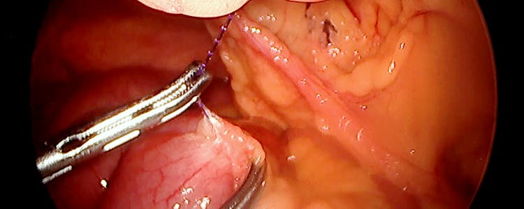 small-bowel-obstruction-following-robotic-transabdominal-preperitoneal-ventral-hernia-repair-(rtapp)-due-to-barbed-suture