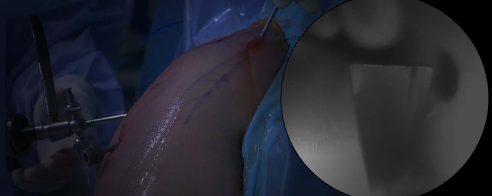 arthroscopic-total-shoulder-resurfacing-with-osteochondral-allograft
