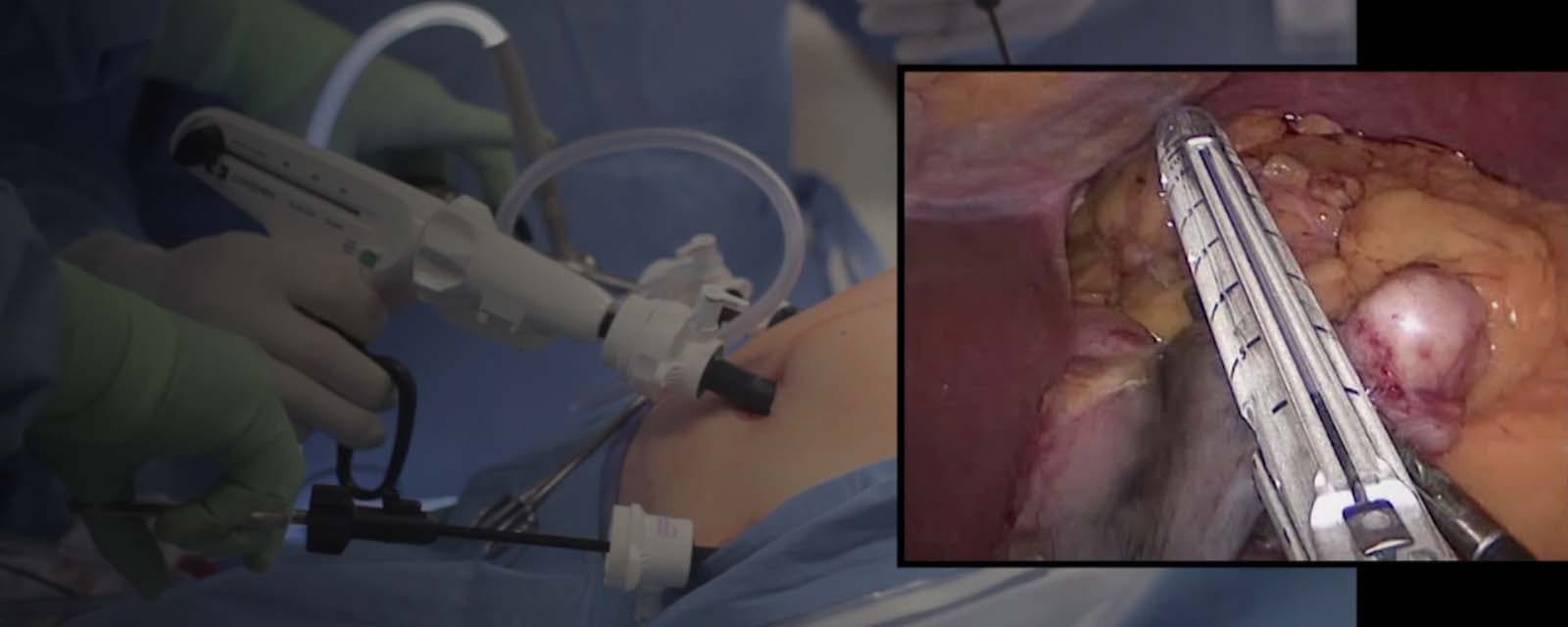 laparoscopic-gastric-wedge-resection