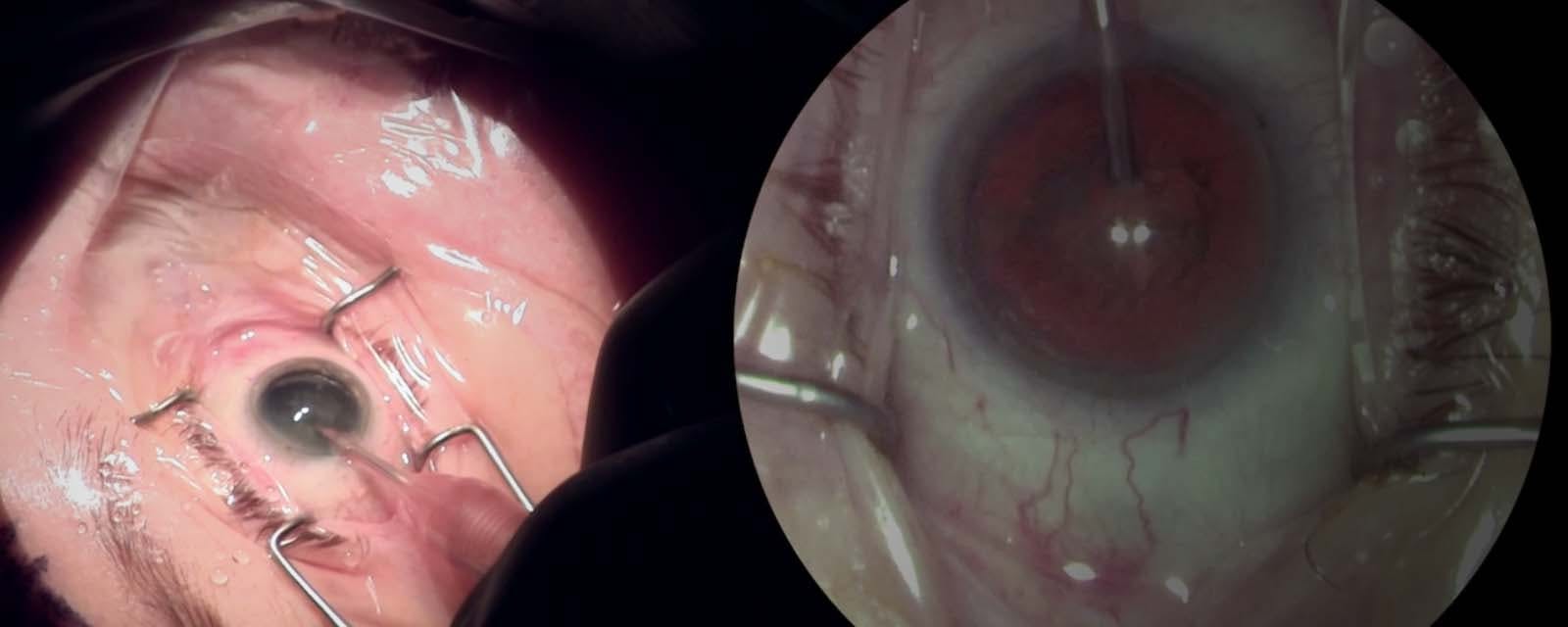 Cataract-Extraction-with-Phacoemulsification-and-Posterior-Chamber-Intraocular-Lens