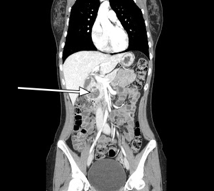 Sagittal CT revealing a 3.5-cm enhancing lesion associated with the head of the pancreas.