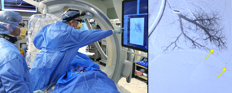 Pulmonary AVM Embolization | Journal of Medical Insight