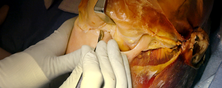 Video コロナルアプローチ(死体) | Journal of Medical Insight