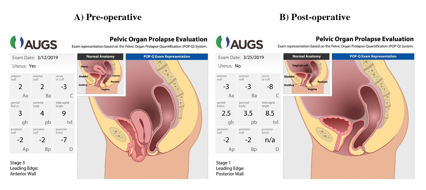 Posterior repair