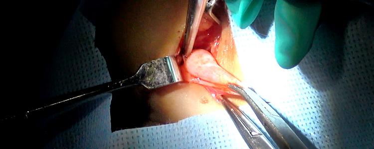 Inguinal hernia repair (child)