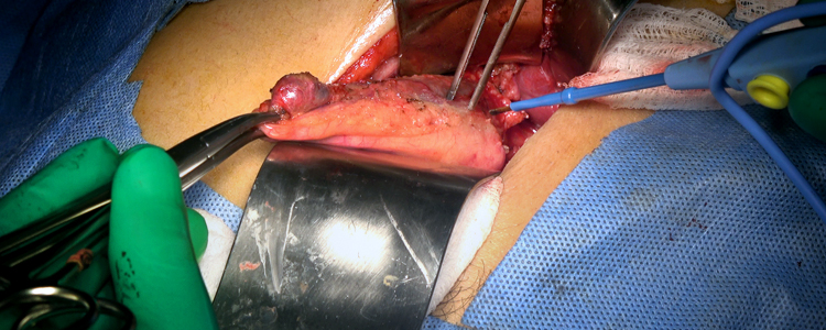 gallbladder stones operation video
