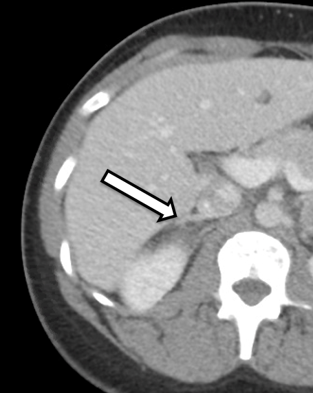 Enhanced view of CT of the abdomen demonstrating normal adrenal cortex (arrow) of the right adrenal gland that was preserved.