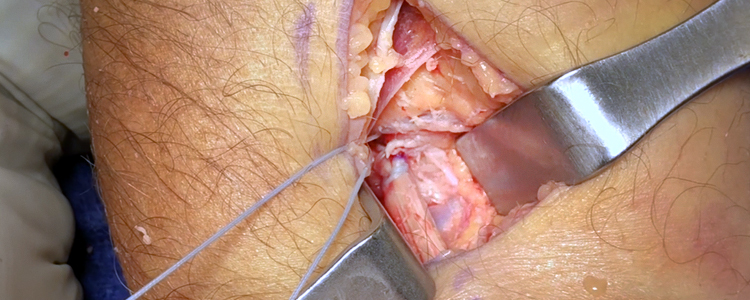 Biceps Tenodesis for Distal Biceps Tendon Repair | Journal of Medical Insight