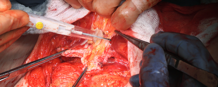 Anterior Component Separation for Multiple Incisional Hernias