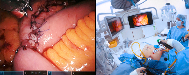 Endoscopic Stent Placement for Esophageal Strictures