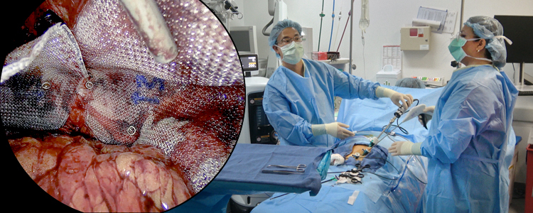 Video 全腹膜外(TEP)技術を用いた両側腹腔鏡下鼠径ヘルニア修復術