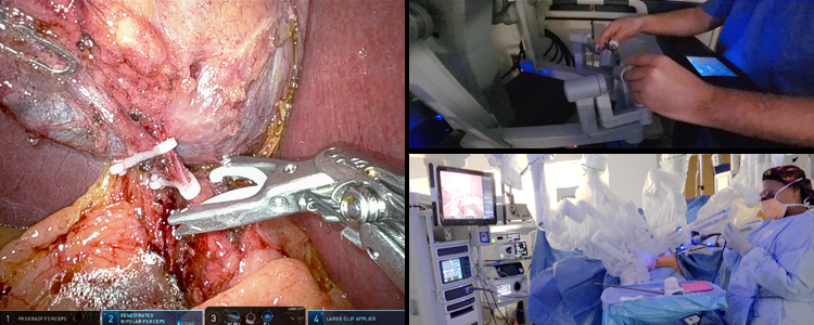 Robotic Cholecystectomy for Recurrent Gallstone Pancreatitis in a ...