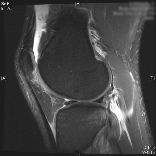 ACL MRI Lateral Bone Edema