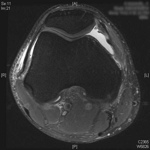 ACL MRI Patella Femoral