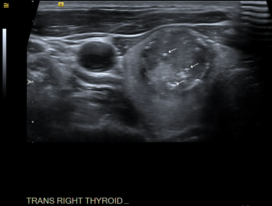 Vista transversal del nódulo dentro del lóbulo tiroideo derecho; las flechas blancas indican microcalcificaciones.